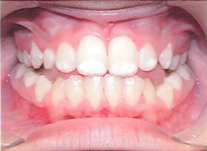 teeth-of-nemphos